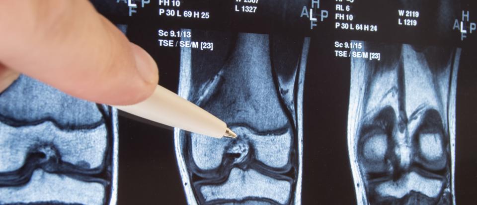 Lower extremity joint replacement
