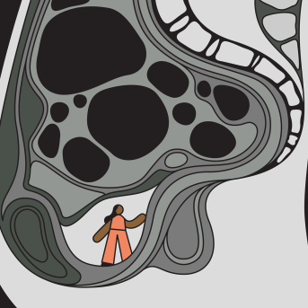 Illustration of a woman trapped inside an MRI image of a uterus filled with fibroids.