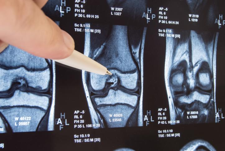 Lower extremity joint replacement