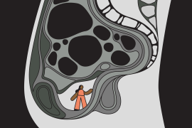 Illustration of a woman trapped inside an MRI image of a uterus filled with fibroids.